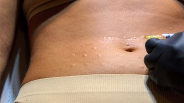 MESOTERAPIA