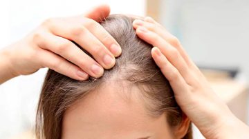 alopecia